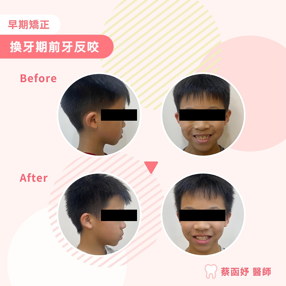 兒童早期矯正案例：7–8 歲換牙期地包天（前牙反咬），治療前後側臉與正面照對照