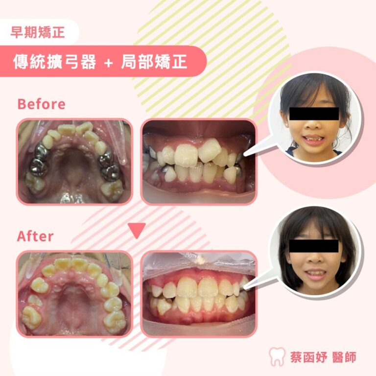 傳統擴弓器＋局部矯正案例：8–9 歲牙齒擁擠與牙弓空間不足，治療前後口內照與臉部照對照