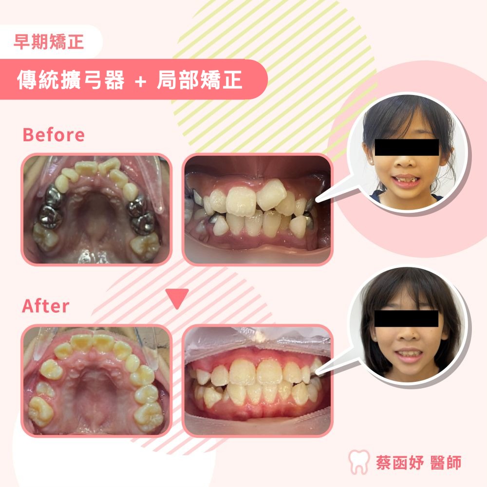 傳統擴弓器＋局部矯正案例：8–9 歲牙齒擁擠與牙弓空間不足，治療前後口內照與臉部照對照
