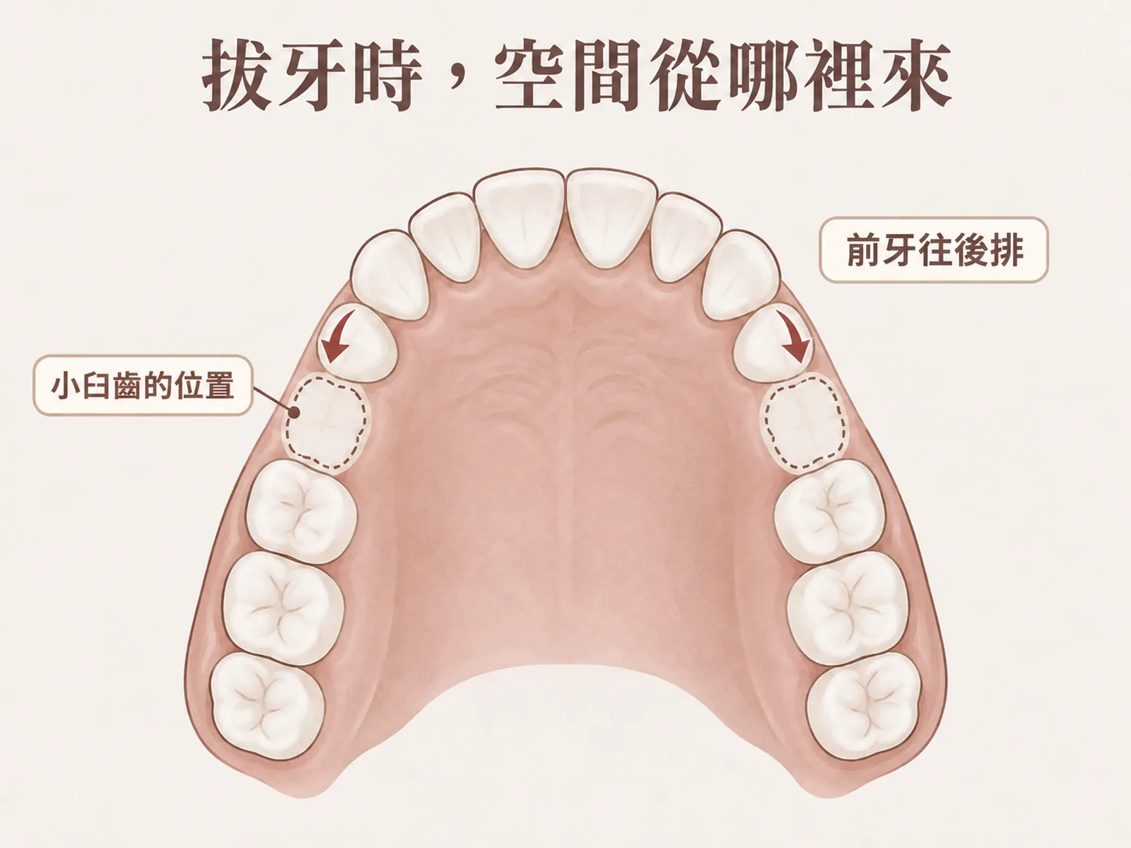 拔牙矯正示意：拔除左右小臼齒讓出空間，前牙往後排列