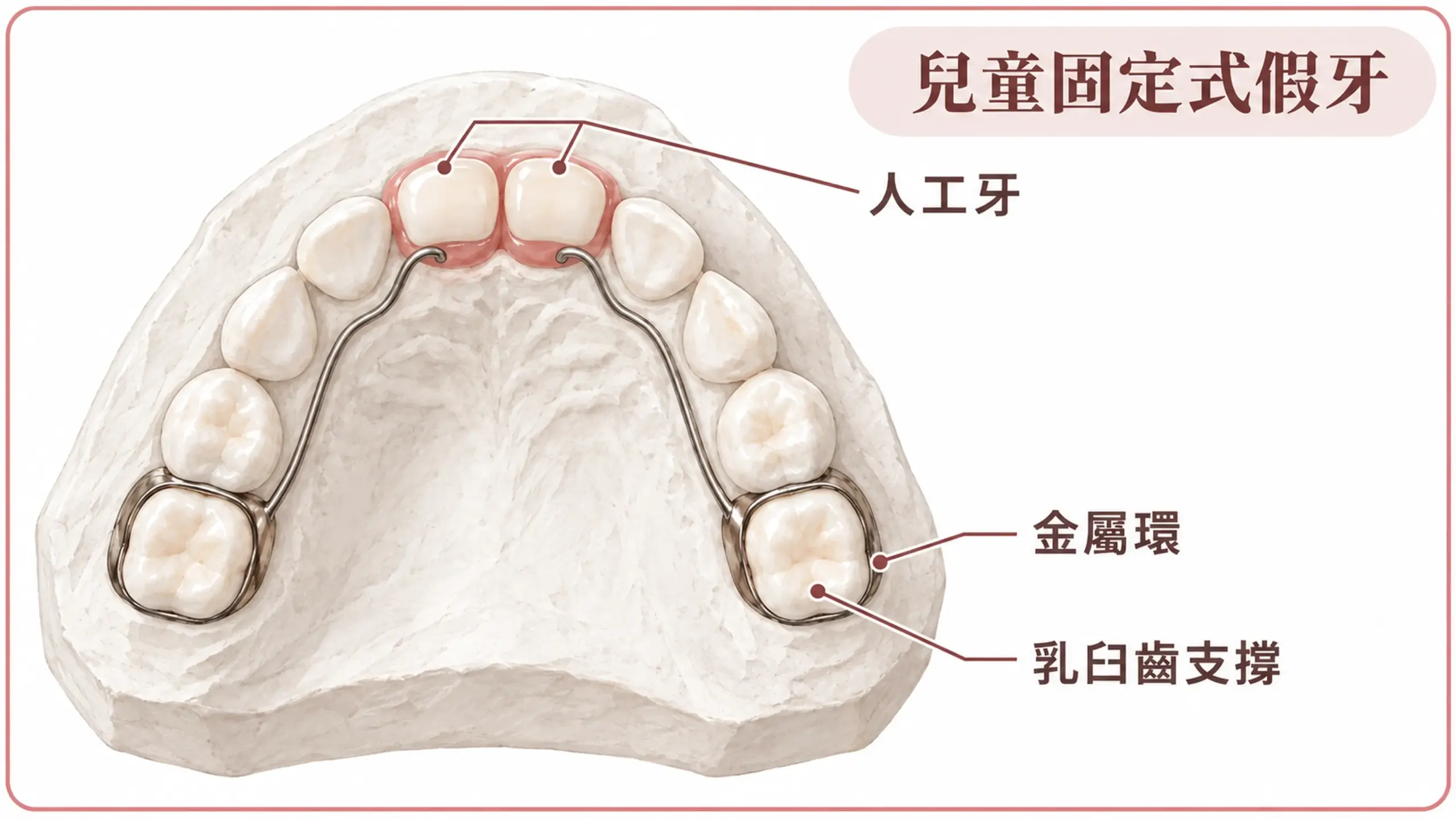 兒童固定式假牙示意，白色上顎乳牙牙模的兩側乳臼齒套著金屬環，金屬線沿上顎內側連到補在兩顆正中門牙位置的人工牙。
