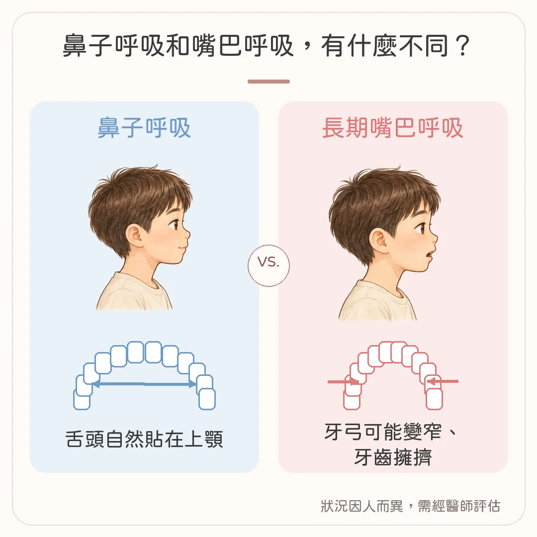 鼻子呼吸與長期嘴巴呼吸的對照：舌頭位置與牙弓寬度的差異