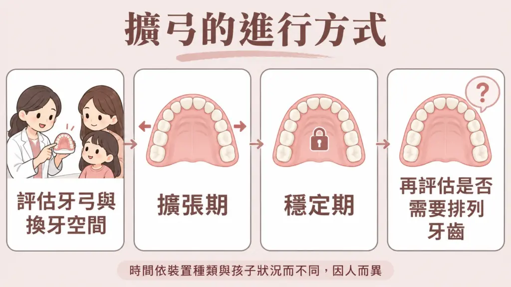 兒童擴弓器的進行方式示意：評估牙弓與換牙空間、擴張期、穩定期、再評估是否需要排列牙齒