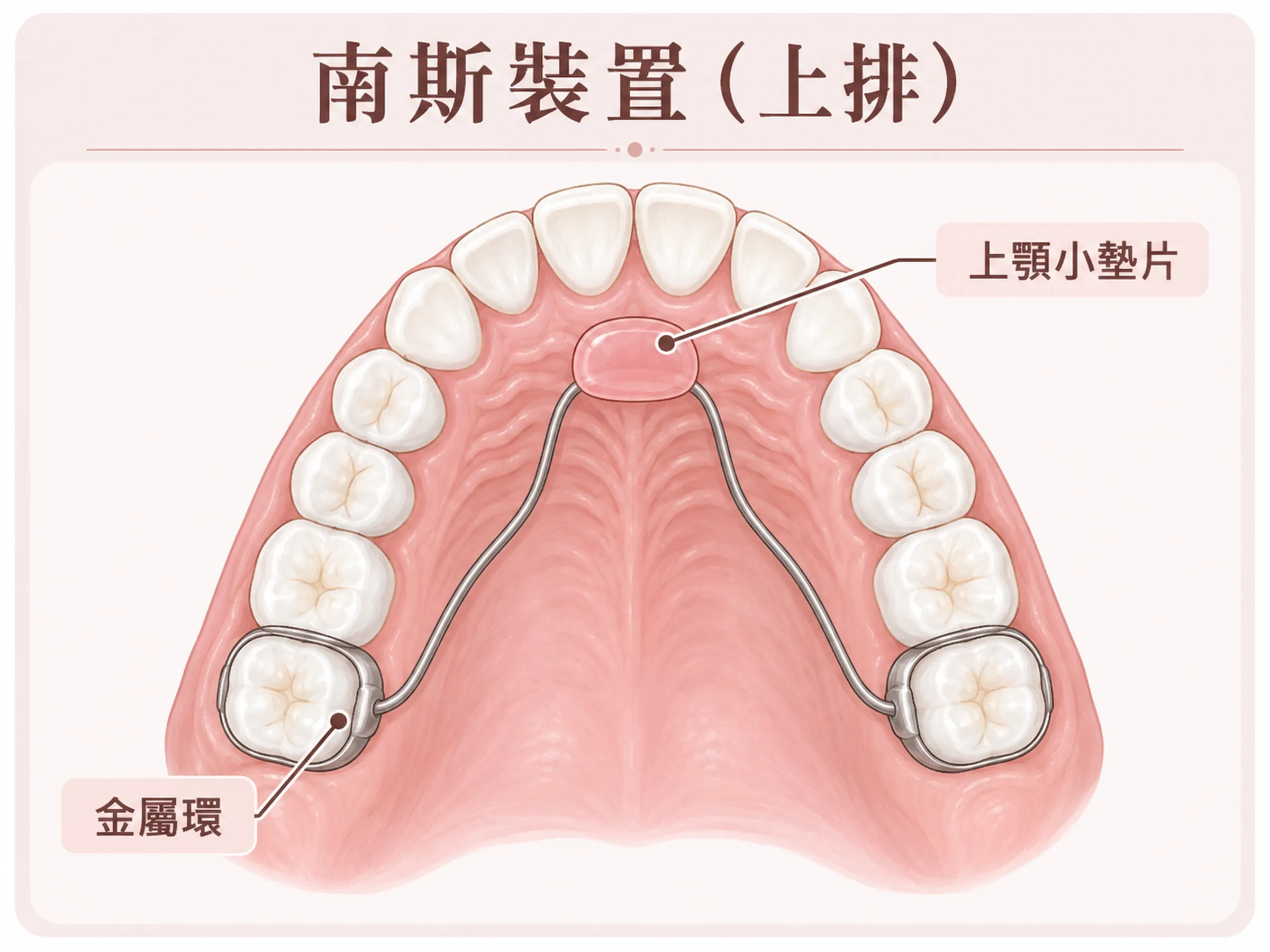 上排南斯空間維持器俯視示意，兩側大臼齒的金屬環連接鋼絲與上顎前方的玫瑰色小墊片。