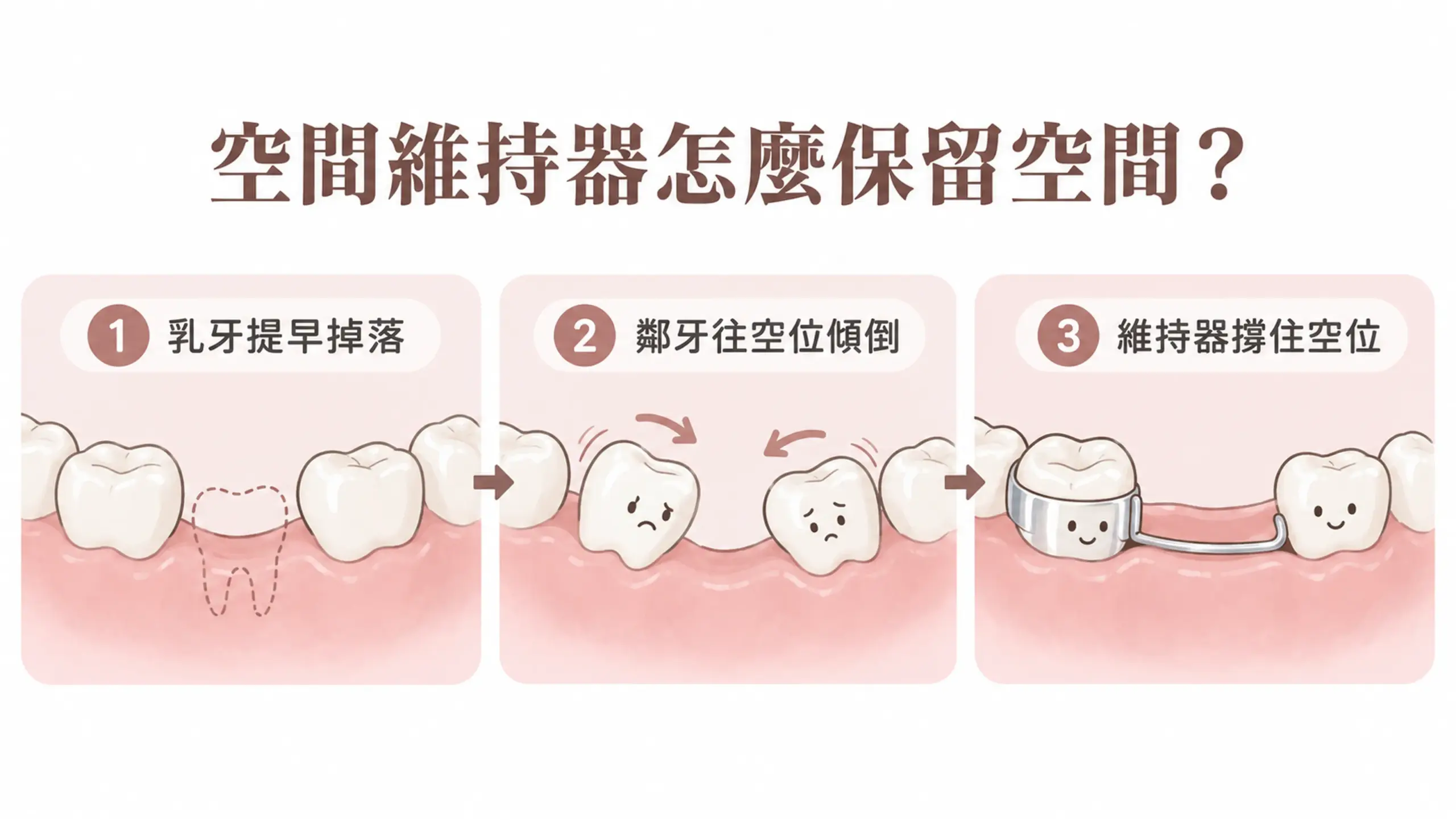 空間維持器三步驟示意：乳牙提早掉落、鄰牙往空位傾倒，以及帶環線圈撐住空位。