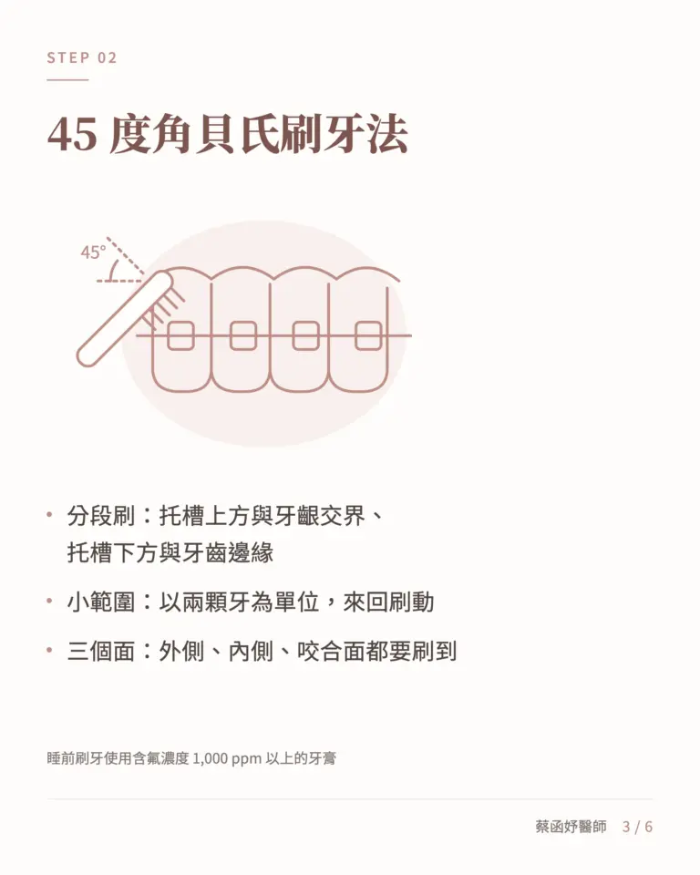 傳統矯正清潔第二步:45 度角貝氏刷牙法,分段刷托槽上下方