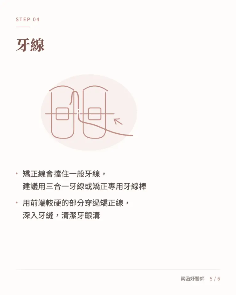 傳統矯正清潔第四步:用三合一牙線或矯正牙線棒穿過矯正線清潔牙縫