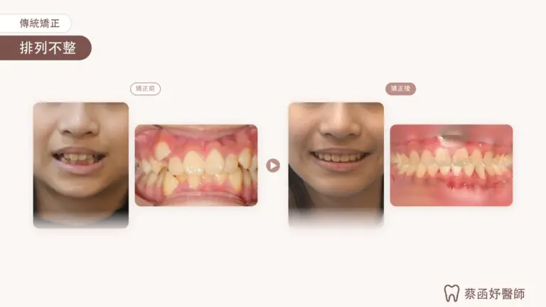青少年傳統矯正拔牙案例:治療前後正面臉型與正面齒列比對