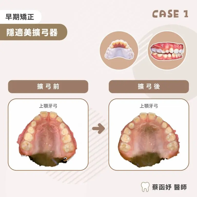隱適美擴弓器兒童後牙錯咬案例照片