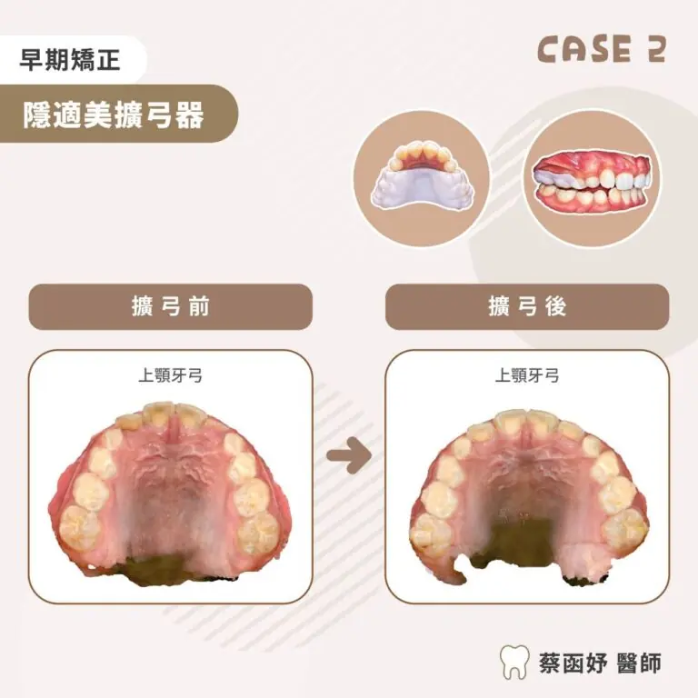 隱適美擴弓器：8 歲上顎牙弓狹窄，擴弓前後的牙弓形態對照