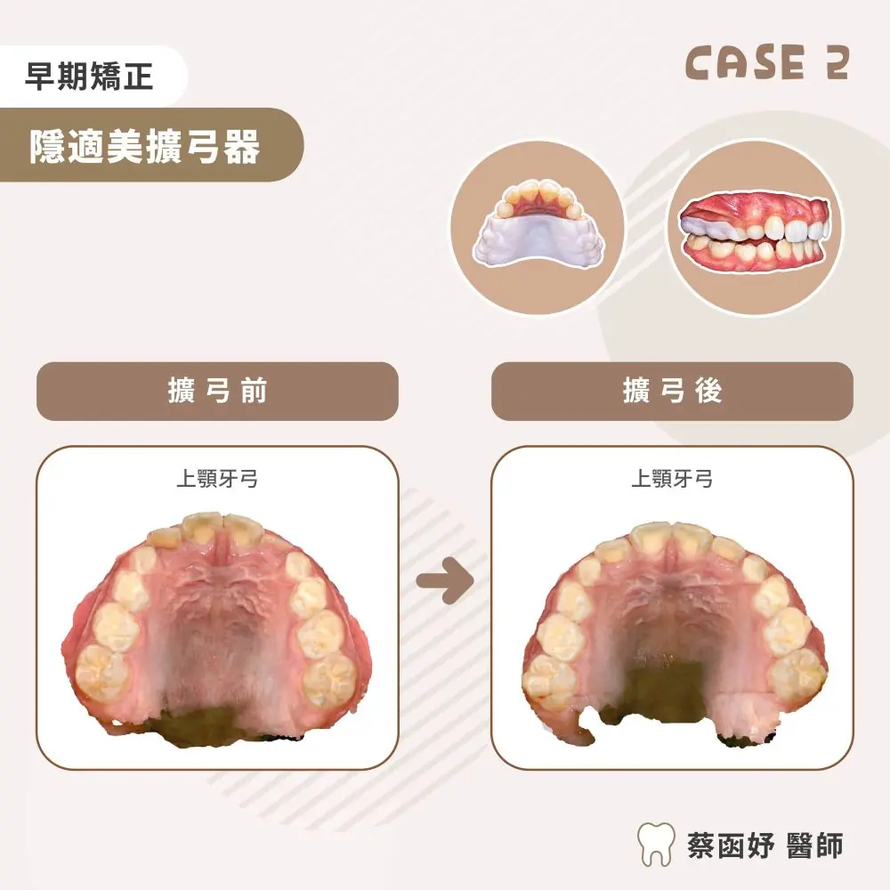 隱適美擴弓器兒童牙弓狹窄案例照片