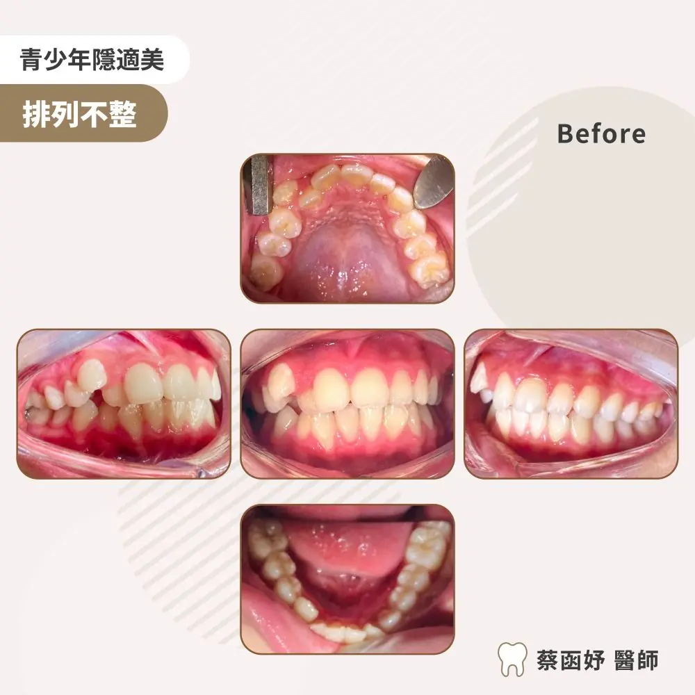 青少年隱適美虎牙長太高案例：治療前口內照片