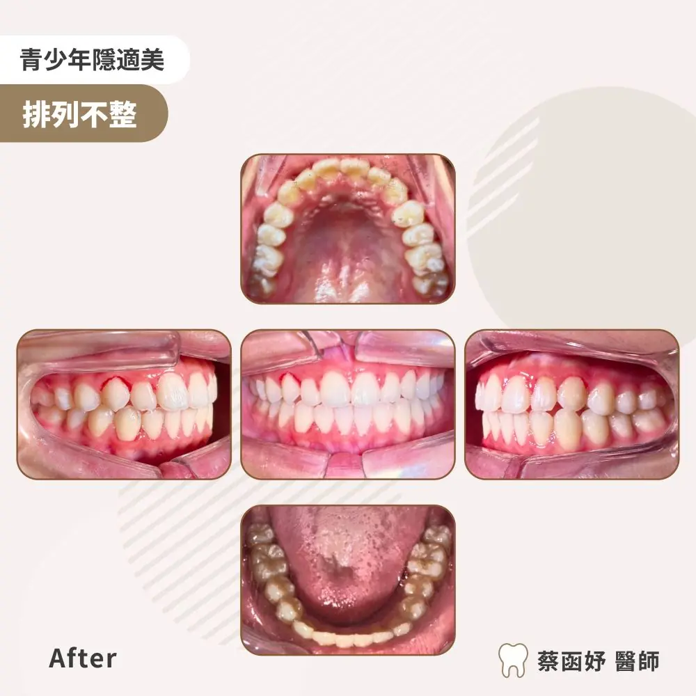 青少年隱適美虎牙長太高案例：治療後口內照片