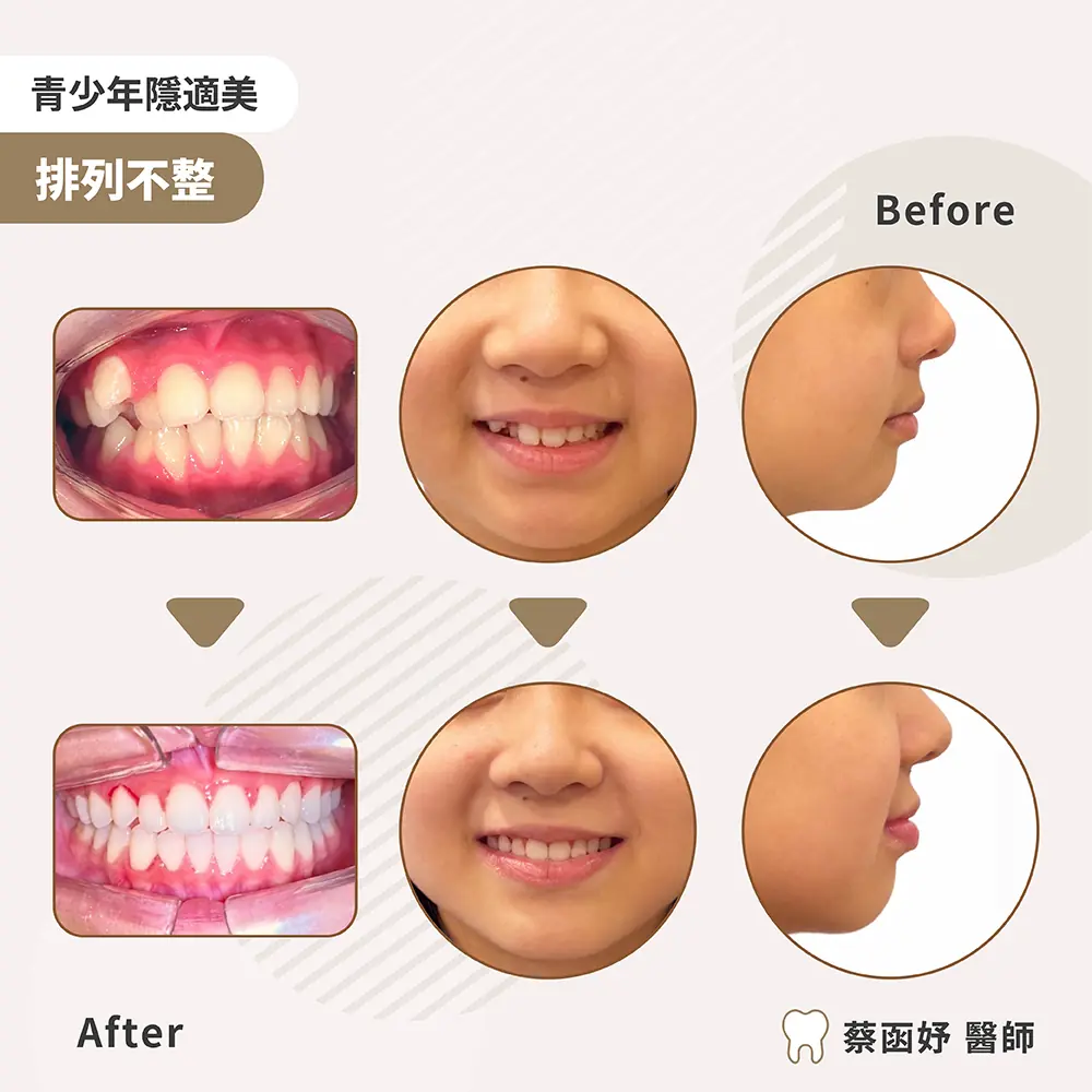 青少年隱適美：10–11 歲虎牙高位，治療前後齒列與側臉對照